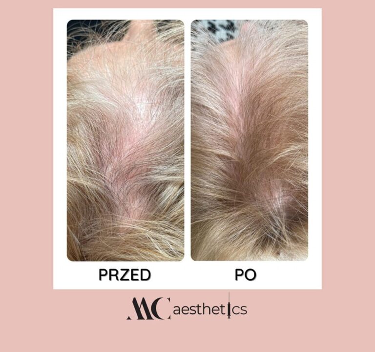 Mezoterapia skóry głowy